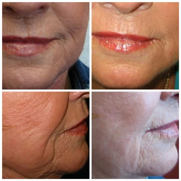 before and after filler