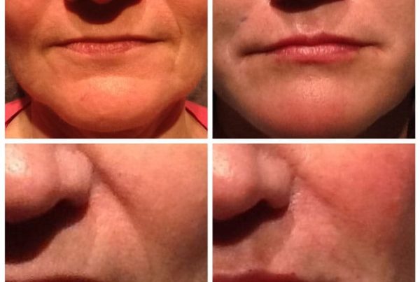 before and after filler