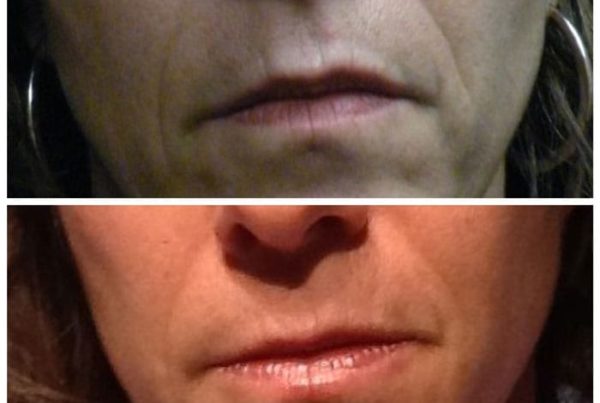 before and after filler