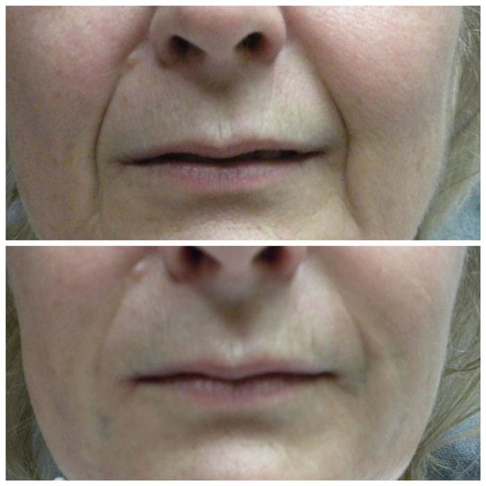 before and after filler