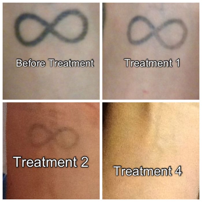 before and after laser tattoo remal